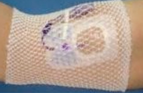 ProNet pre-cut tubular gauze on a patient's arm